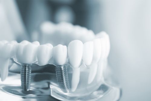 So sánh cầu răng sứ với cấy Implant – Giải pháp nào phục hồi răng mất hiệu quả hơn?