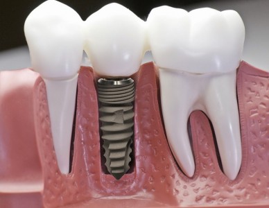 Bí Quyết Giúp Tăng Tuổi Thọ Của Trụ Implant – Giữ Gìn Răng Giả Như Răng Thật