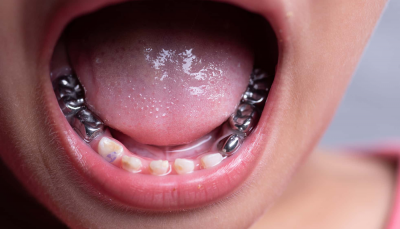 Chụp Thép Răng Trẻ Em Uy Tín Tại Thái Bình – Giải Pháp Bảo Vệ Răng Sữa Tối Ưu Cho Bé