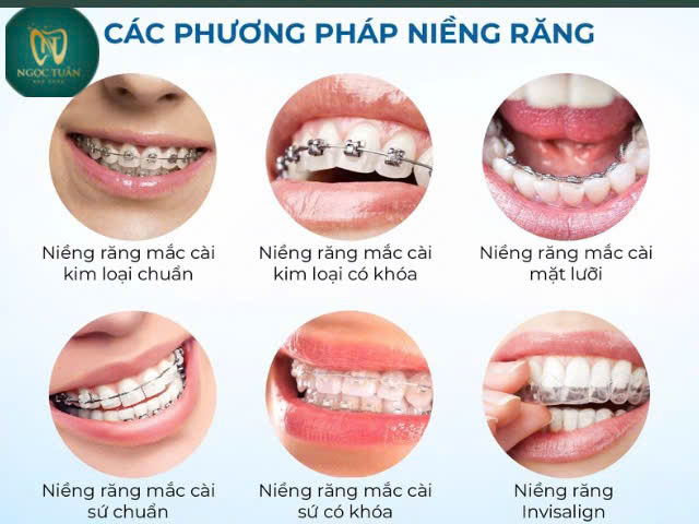 các phương pháp niềng răng