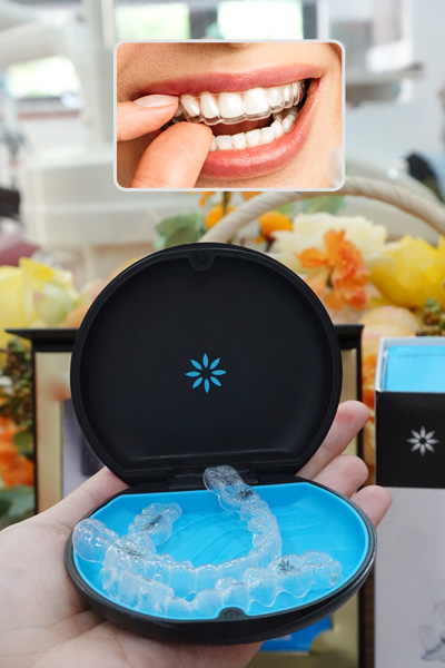 Niềng răng trong suốt