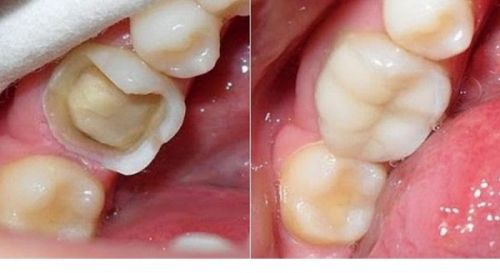 Hàn Răng Trẻ Em Uy Tín Tại Thái Bình – Bố Mẹ Nên Chọn Địa Chỉ Nào Để Yên Tâm?