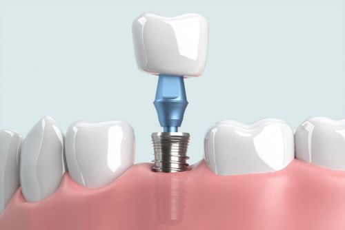 Trồng răng Implant uy tín tại Thái Bình – Giải pháp phục hồi răng mất hiệu quả nhất