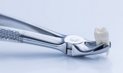 Niềng Răng Có Phải Nhổ Răng Không? – Giải Đáp Từ Chuyên Gia Nha Khoa