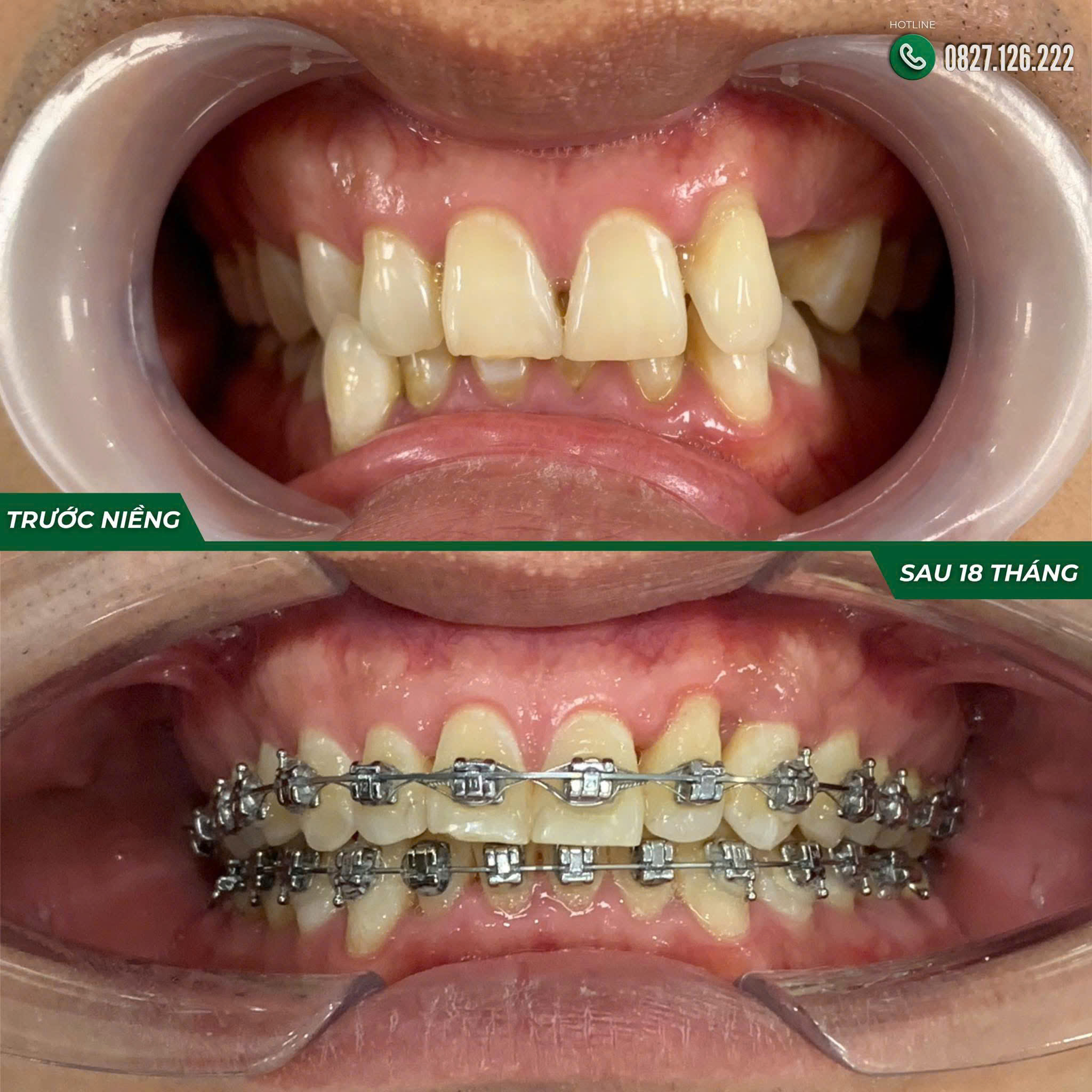 Niềng Răng Mắc Cài Tự Buộc