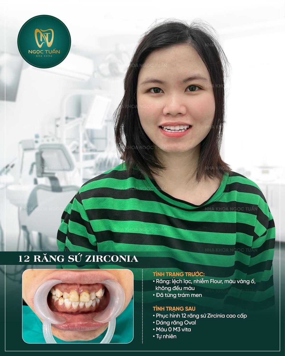 Răng Sứ Zirconia