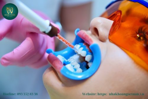 Tẩy Trắng Răng Bằng Laser Ở Hưng Hà – Giữ Được Bao Lâu?