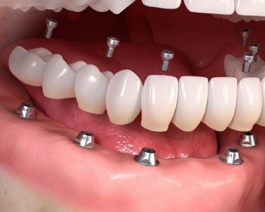 ⚠️ HẬU QUẢ CỦA TRỒNG RĂNG IMPLANT GIÁ RẺ – ĐỪNG ĐỂ MẤT CẢ TIỀN LẪN SỨC KHỎE!