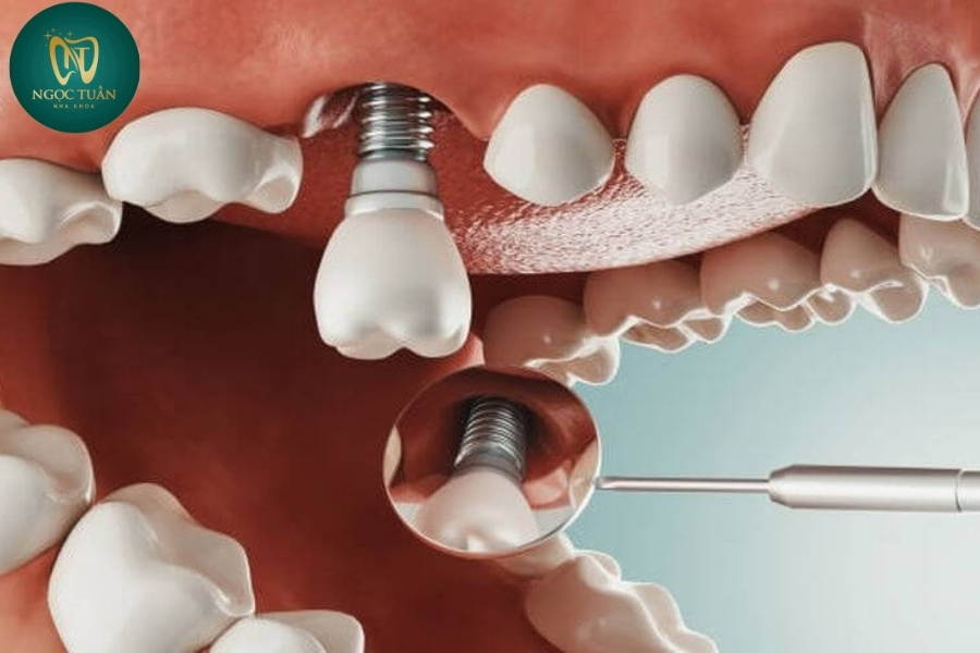 Trồng răng trụ Implant Mỹ
