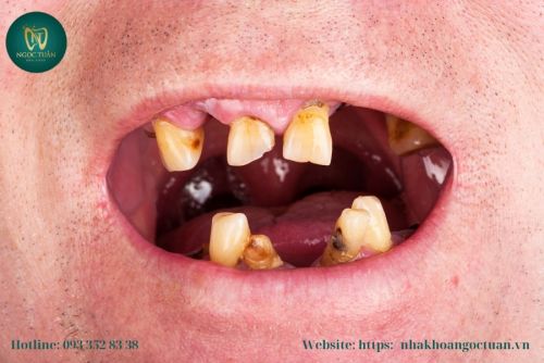 Tẩy Trắng Răng Cho Người Hút Thuốc Ở Thái Thụy – Giải Pháp Tốt Nhất